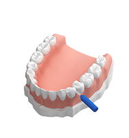 Professionelle Zahnrinigung - 3. Reinigung der Zahnzwischenräume