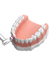 Professionelle Zahnrinigung - 5. Politur / Oberflächenglättung - Schutz gegen neuen Zahnbelag