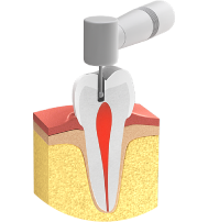 Endodontie - Erkrankte Wurzel Endodontie - Erkrankte Wurzel