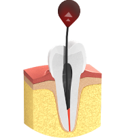 Endodontie - Entfernen der Pulpa und Reinigung der Kanäle Endodontie - Entfernen der Pulpa und Reinigung der Kanäle