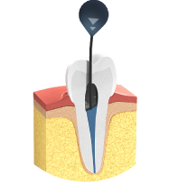 Endodontie - Füllung des Wurzelkanals mit biokompatiblem Medi- kament Endodontie - Füllung des Wurzelkanals mit biokompatiblem Medi- kament