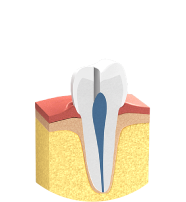 Endodontie - Gefüllter Zahn Endodontie - Gefüllter Zahn