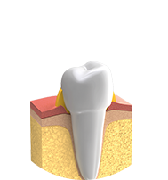 Parodontologie - Erkranktes Zahnfleisch ist gerötet, blutet leicht und ist am Zahnhals häufig leicht geschwollen