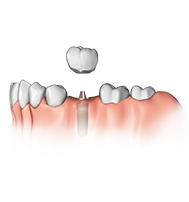 Ein Zahn fehlt  Ein Implantat hat gegenüber einer Brücke den Vorteil, dass Nachbarzähne nicht beschliffen werden müssen.