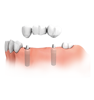 Mehrere Zähne fehlen  Die fehlenden Zähne werden durch Implantate ersetzt, auf die eine Brücke aufgesetzt wird. Nachbarzähne bleiben voll erhalten.